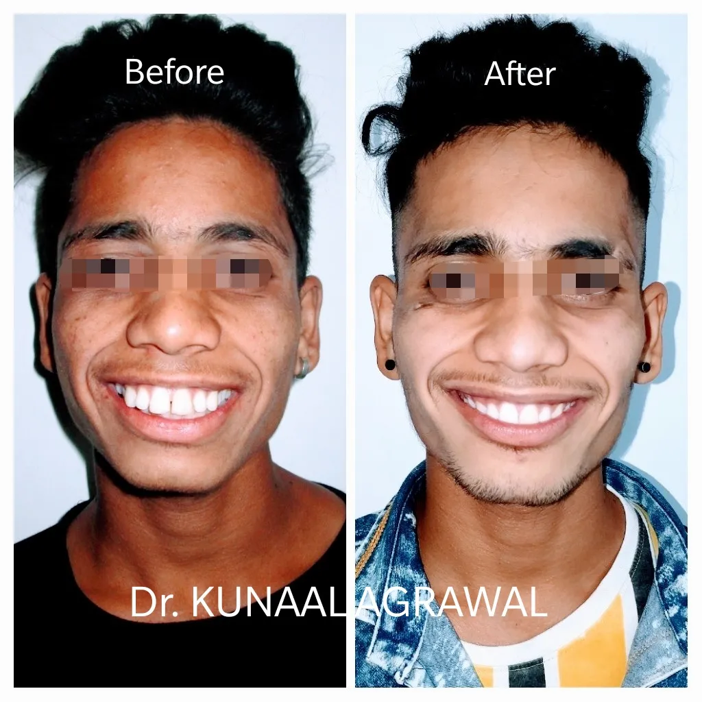 braces before and after bhopal 1